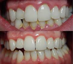 before and after my gums