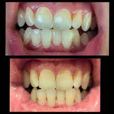 beforeandafterteeth